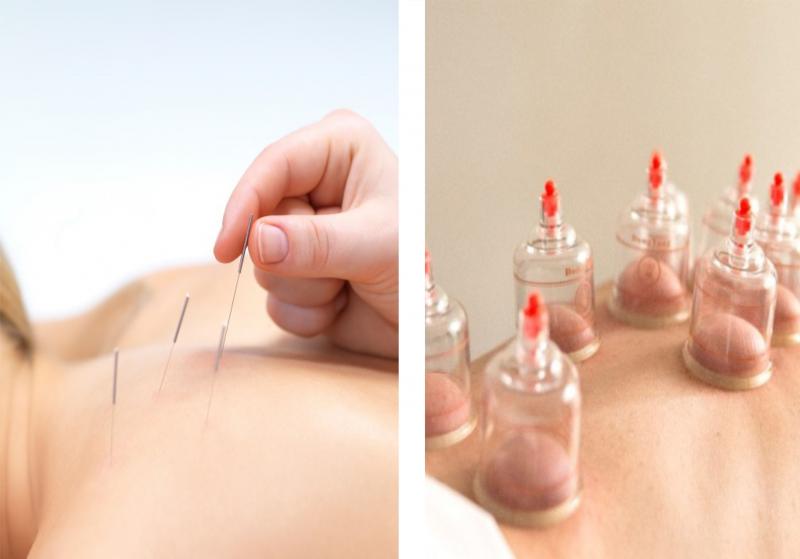 CURSO DE DRY NEEDLING E VENTOSATERAPIA 